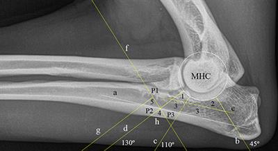 Digital Analysis of Subtrochlear Sclerosis in Elbows Submitted for Dysplasia Screening